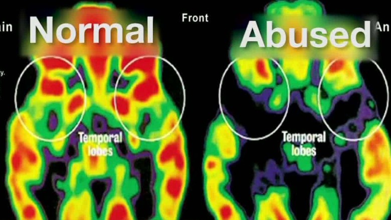 Effects Of Early Childhood Trauma On Brain Development