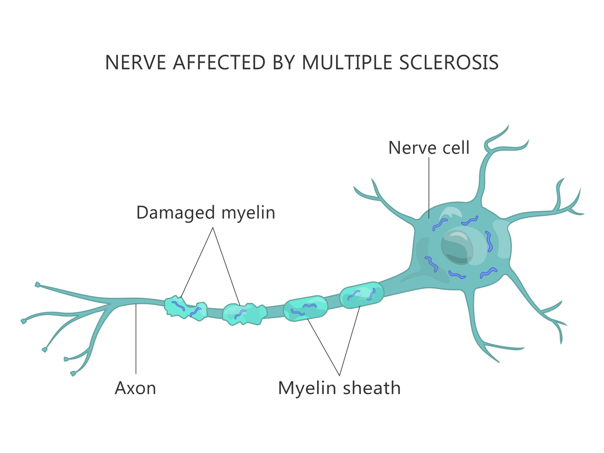 multiple sclerosis nerves