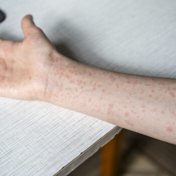 Hand covered in a measles rash.