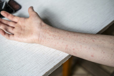 Hand covered in a measles rash.