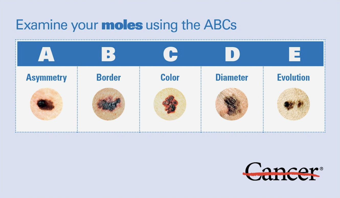 Examine your moles using the ABC's